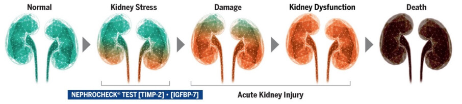 Kidney injury evolution from normal, kidney stress, damage,kidney dysfunction to death.